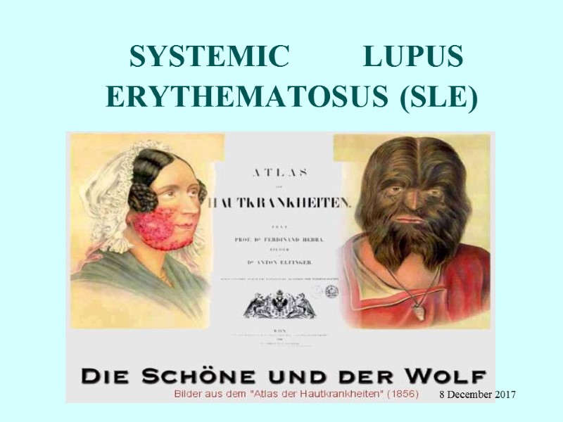 SYSTEMIC         LUPUS ERYTHEMATOSUS (SLE)  8